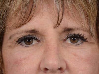 Lower Eyelid Lift with Fat Grafting Before