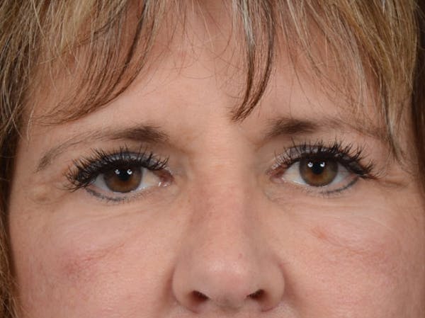 Eyelid Lift Before & After Gallery - Patient 4861743 - Image 1