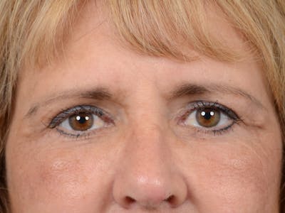 Lower Eyelid Lift with Fat Grafting After