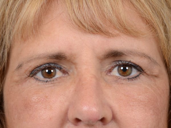 Eyelid Lift Before & After Gallery - Patient 4861743 - Image 2
