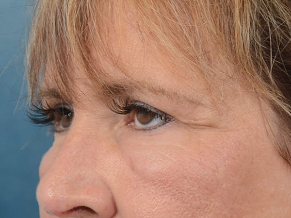Eyelid Lift Before & After Gallery - Patient 4861743 - Image 3