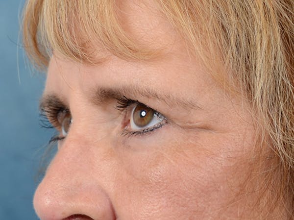 Eyelid Lift Before & After Gallery - Patient 4861743 - Image 4