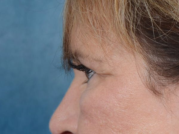 Eyelid Lift Before & After Gallery - Patient 4861743 - Image 5