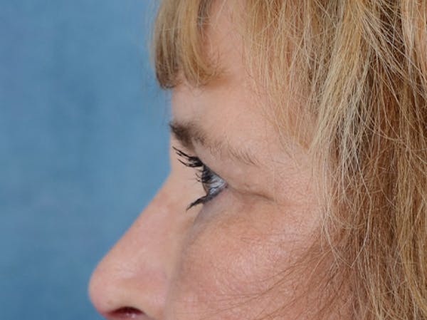 Eyelid Lift Before & After Gallery - Patient 4861743 - Image 6
