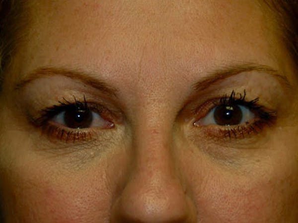 Eyelid Lift Before & After Gallery - Patient 4521016 - Image 1