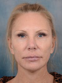 Laser Skin Resurfacing Before & After Gallery - Patient 5205187 - Image 1