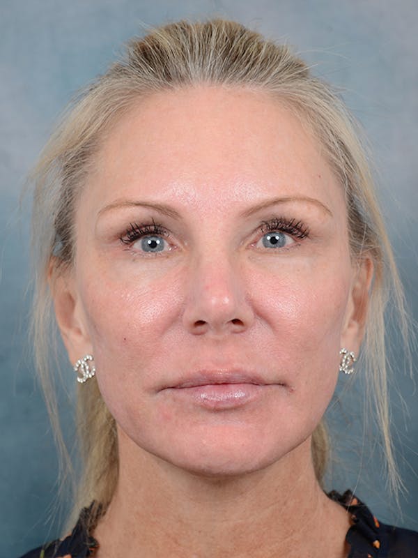 Laser Skin Resurfacing Before & After Gallery - Patient 5205187 - Image 2