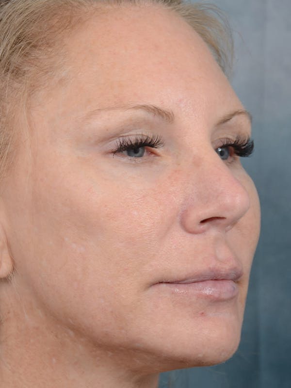Laser Skin Resurfacing Before & After Gallery - Patient 5205187 - Image 3