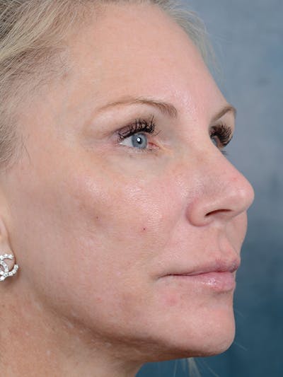 Laser Skin Resurfacing Before & After Gallery - Patient 5205187 - Image 4