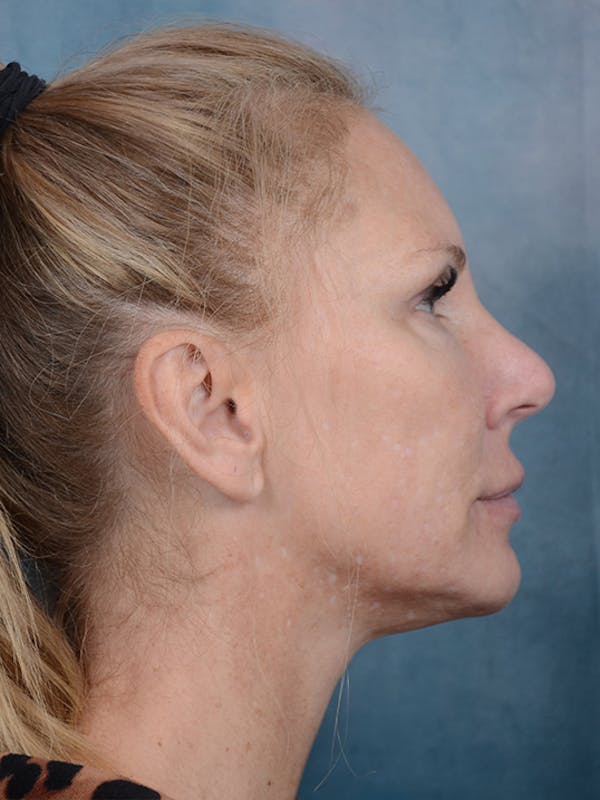 Laser Skin Resurfacing Before & After Gallery - Patient 5205187 - Image 5