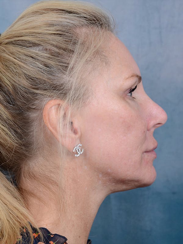 Laser Skin Resurfacing Before & After Gallery - Patient 5205187 - Image 6