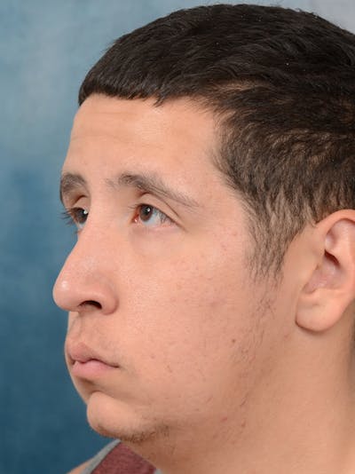 Rhinoplasty Before & After Gallery - Patient 5219825 - Image 6