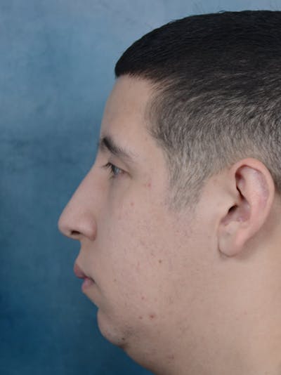 Rhinoplasty Before & After Gallery - Patient 5219825 - Image 1