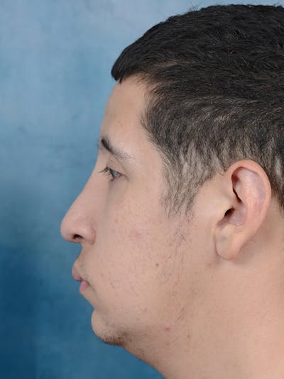 Rhinoplasty Before & After Gallery - Patient 5219825 - Image 2