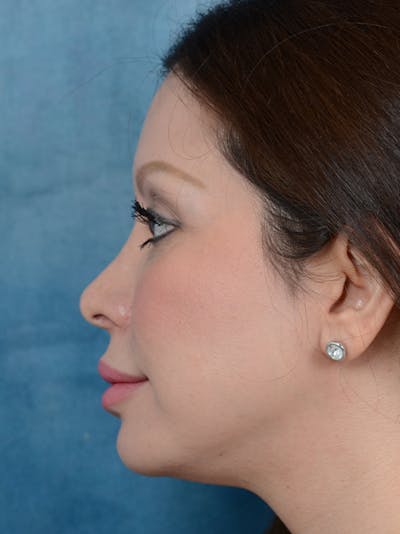 Revision Rhinoplasty Before & After Gallery - Patient 66235037 - Image 1