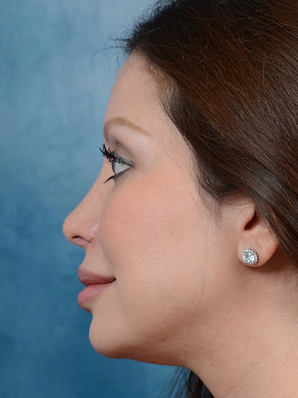 Revision Rhinoplasty Before & After Gallery - Patient 66235037 - Image 2