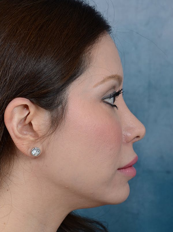 Revision Rhinoplasty Before & After Gallery - Patient 66235037 - Image 9