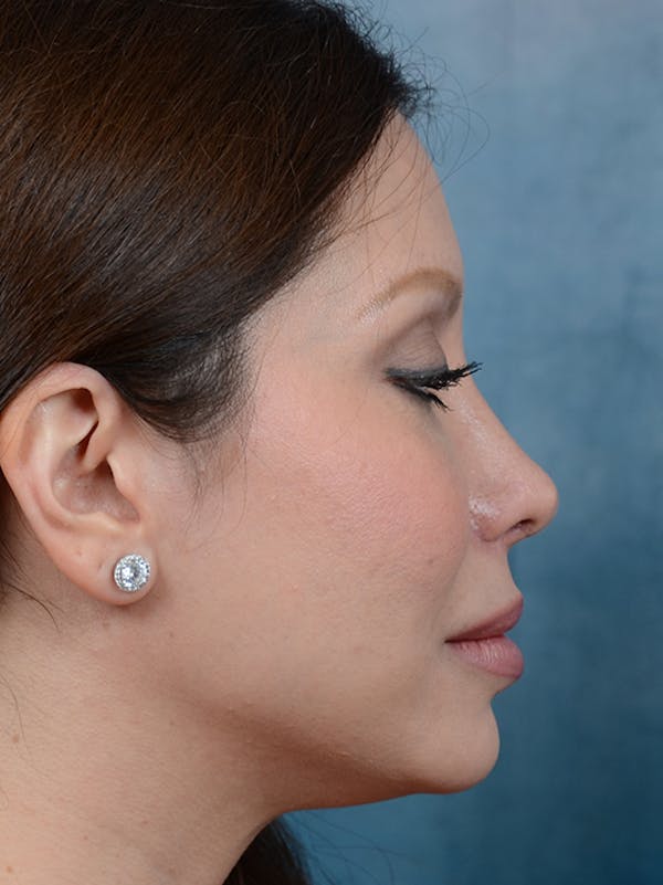 Revision Rhinoplasty Gallery - Patient 66235037 - Image 10
