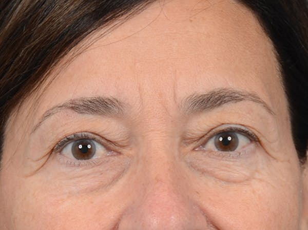 Eyelid Lift Before & After Gallery - Patient 5923298 - Image 1