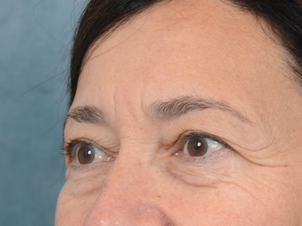 Eyelid Lift Before & After Gallery - Patient 5923298 - Image 3