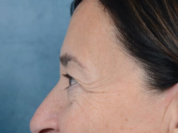 Eyelid Lift Before & After Gallery - Patient 5923298 - Image 5