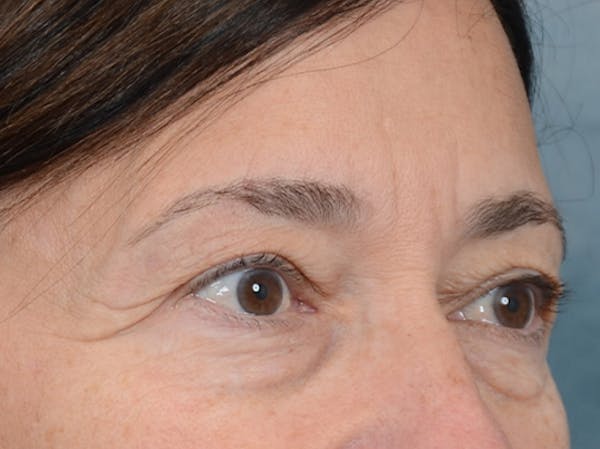 Eyelid Lift Before & After Gallery - Patient 5923298 - Image 7