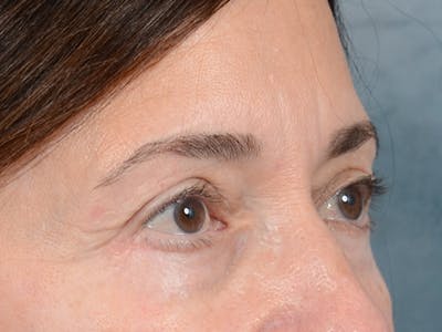 Eyelid Lift Before & After Gallery - Patient 5923298 - Image 8