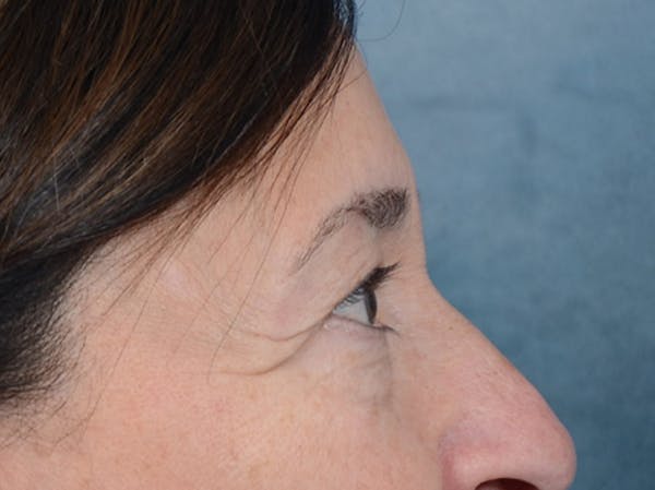 Eyelid Lift Before & After Gallery - Patient 5923298 - Image 9