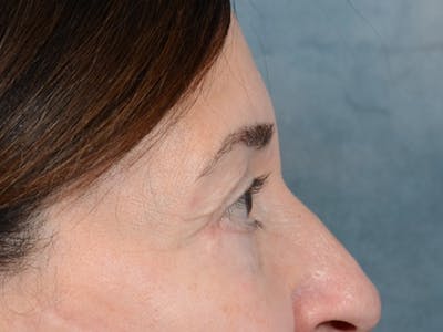 Eyelid Lift Before & After Gallery - Patient 5923298 - Image 10