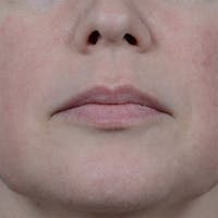 Lip Lift Before & After Gallery - Patient 6157746 - Image 1