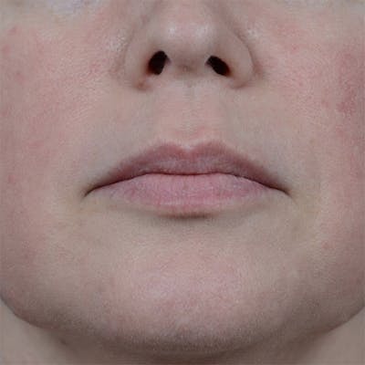 Lip Lift Before & After Gallery - Patient 6157746 - Image 1