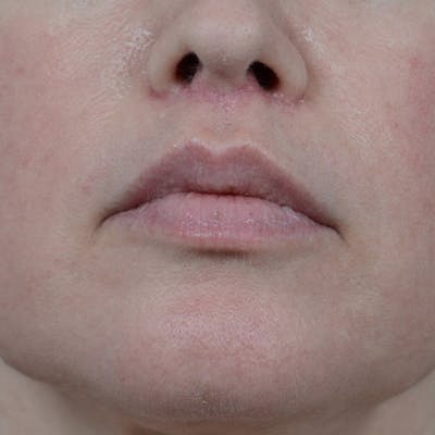 Lip Lift Before & After Gallery - Patient 6157746 - Image 2