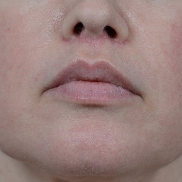 Lip Lift Before & After Gallery - Patient 6157746 - Image 2