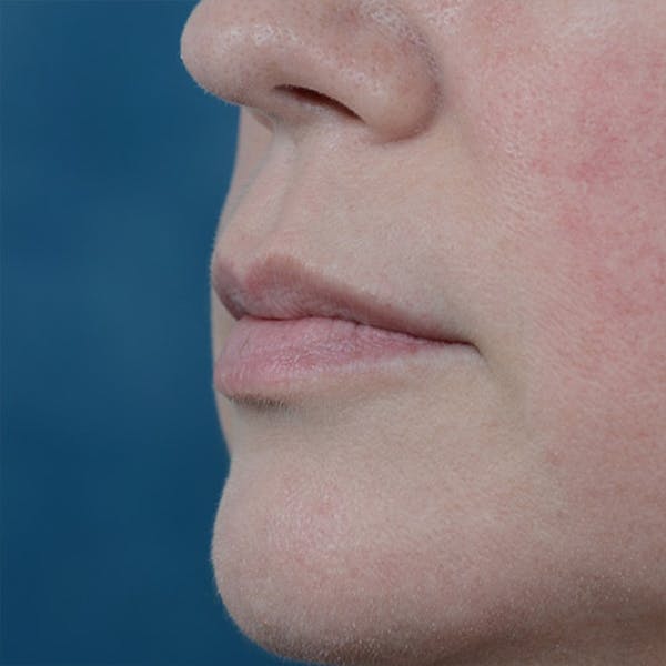 Lip Lift Before & After Gallery - Patient 6157746 - Image 3