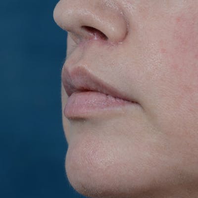 Lip Lift Before & After Gallery - Patient 6157746 - Image 4
