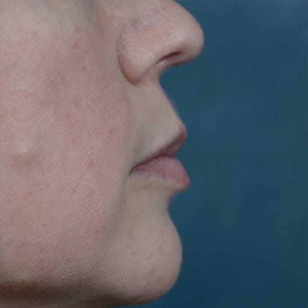 Lip Lift Before & After Gallery - Patient 6157746 - Image 5
