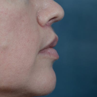 Lip Lift Before & After Gallery - Patient 6157746 - Image 6
