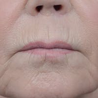 Lip Lift Before & After Gallery - Patient 6279257 - Image 1