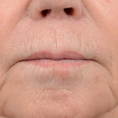 Lip Lift Before & After Gallery - Patient 6279257 - Image 2