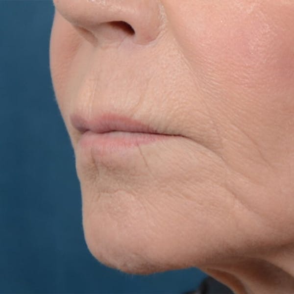 Lip Lift Before & After Gallery - Patient 6279257 - Image 3