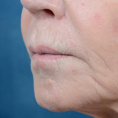 Lip Lift Before & After Gallery - Patient 6279257 - Image 4