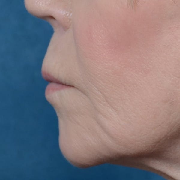 Lip Lift Before & After Gallery - Patient 6279257 - Image 5
