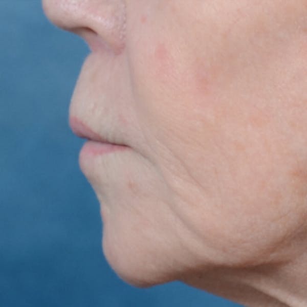 Lip Lift Before & After Gallery - Patient 6279257 - Image 6