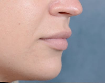 Restylane Before & After Gallery - Patient 6279731 - Image 1
