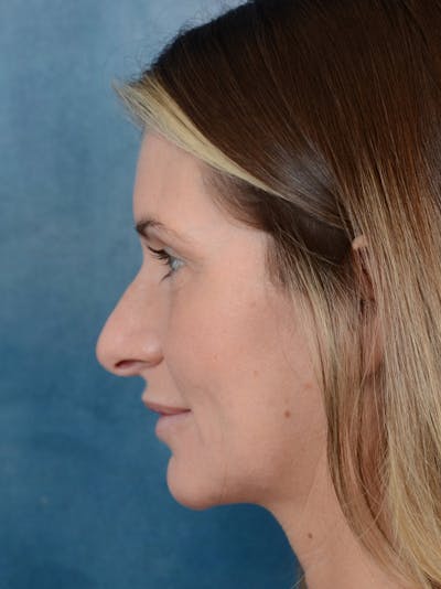 Rhinoplasty Before & After Gallery - Patient 6279838 - Image 1