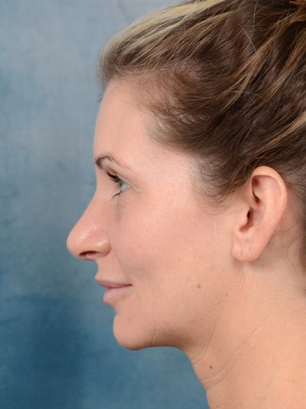 Rhinoplasty Before & After Gallery - Patient 6279838 - Image 2