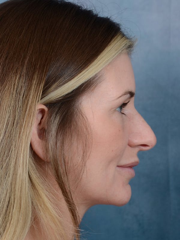 Rhinoplasty Before & After Gallery - Patient 6279838 - Image 9