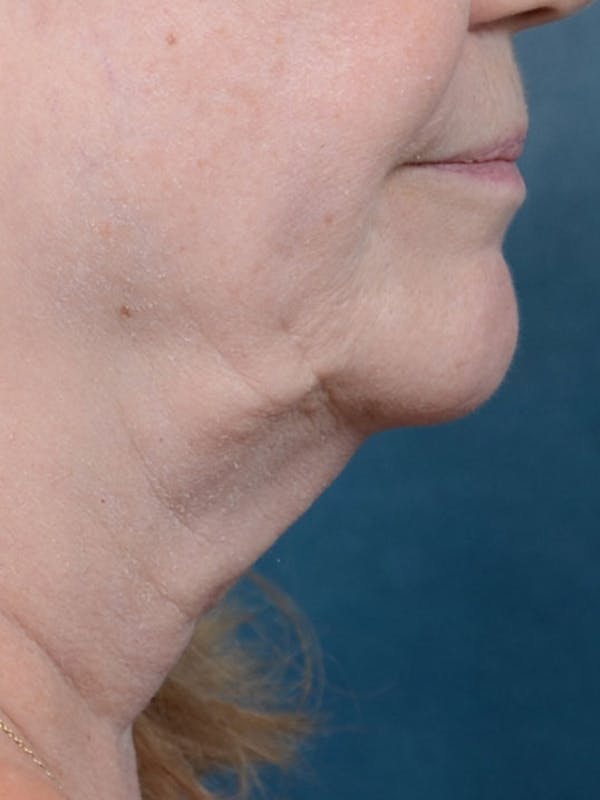 Facetite Before & After Gallery - Patient 8285899 - Image 1