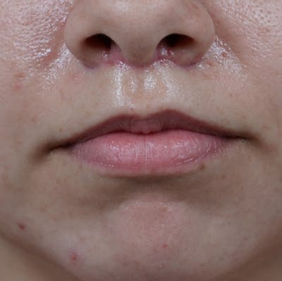 Lip Lift Before & After Gallery - Patient 8341617 - Image 2