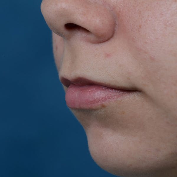 Lip Lift Before & After Gallery - Patient 8341617 - Image 3